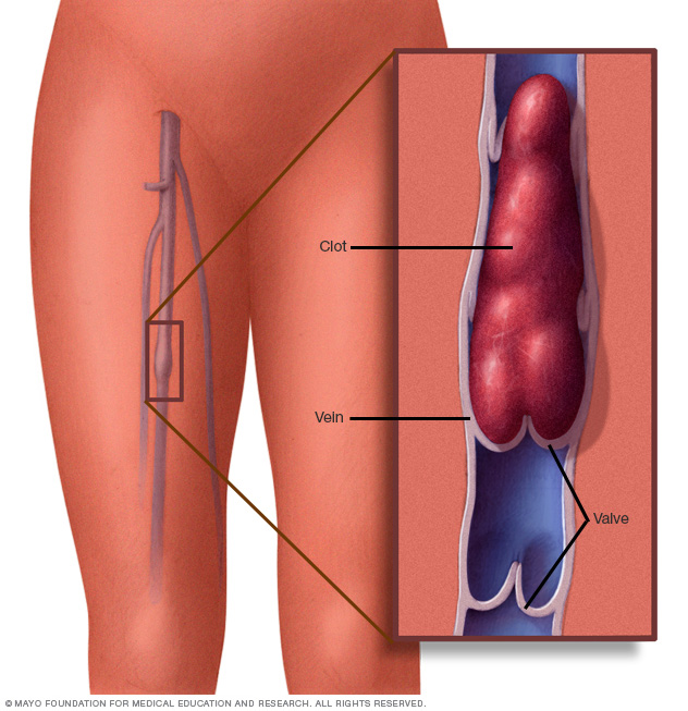 Blood clot in leg vein