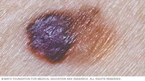 Melanoma con forma asimétrica