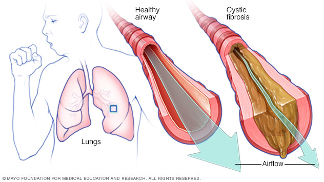 Flema y mucosidad: comprensión de las causas y consejos para eliminar la  flema y la mucosidad de los pulmones