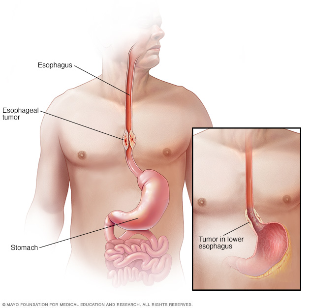 Esophageal cancer