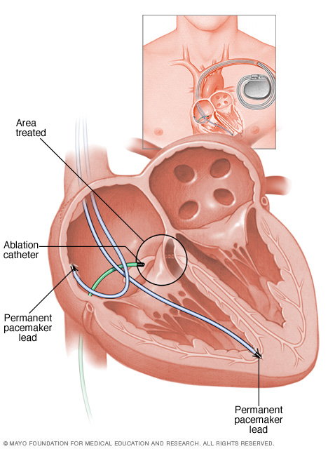 Un corazón durante la ablación del nódulo AV