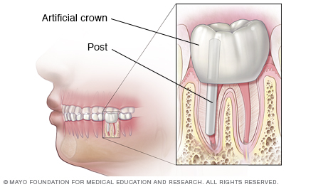 Ilustración que muestra los resultados finales del tratamiento de conducto y la corona