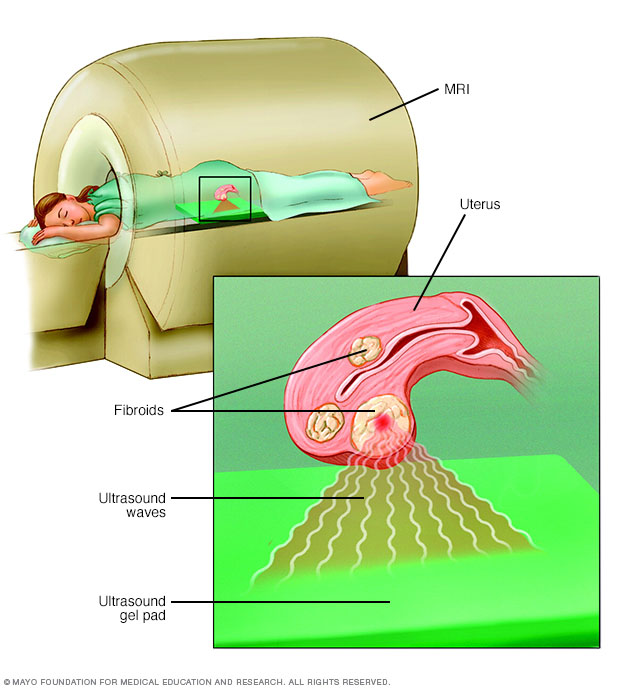 Uterine fibroids // Middlesex Health