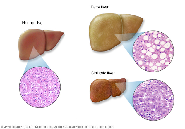 Problemas hepáticos en hígados sanos en comparación con un hígado enfermo