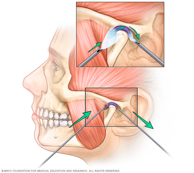 Arthrocentesis for TMJ