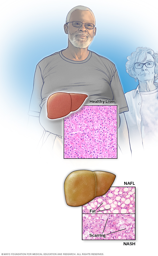 Vista microscópica de un hígado saludable y de un hígado con enfermedad hepática grasa no alcohólica