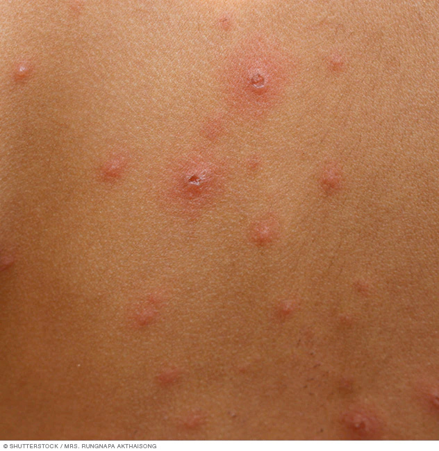 people with chickenpox