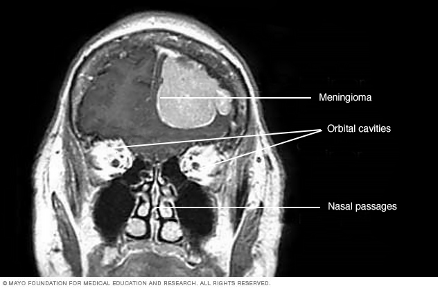 Meningioma // Middlesex Health