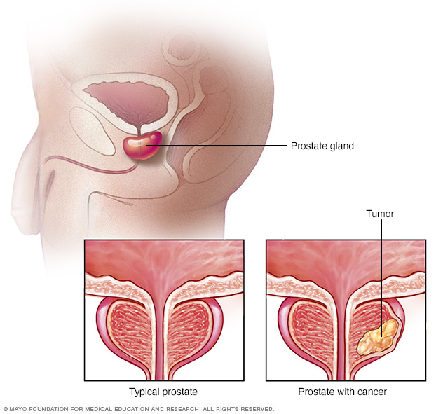 A typical prostate compared to a prostate with cancer