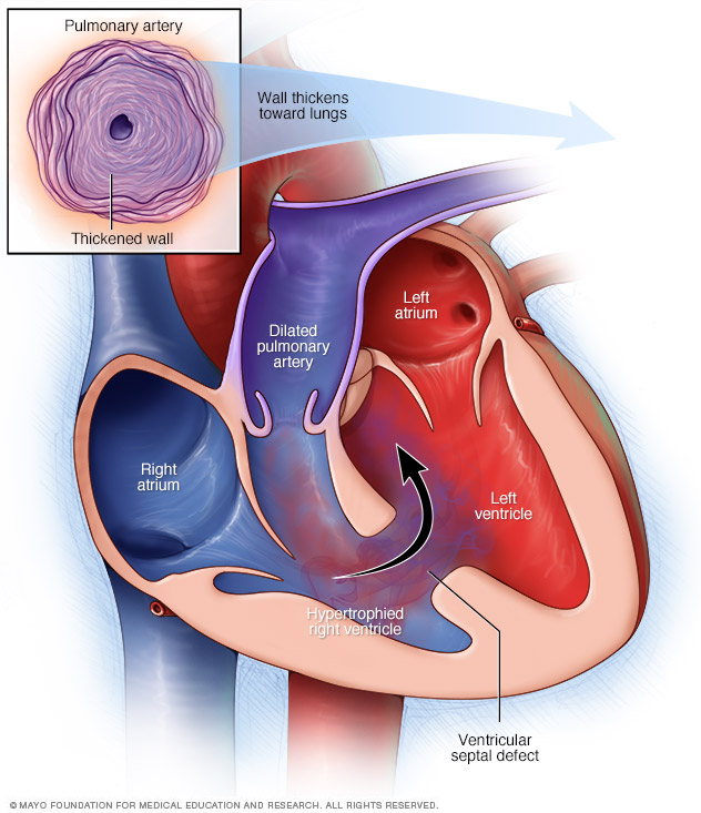 Eisenmenger syndrome