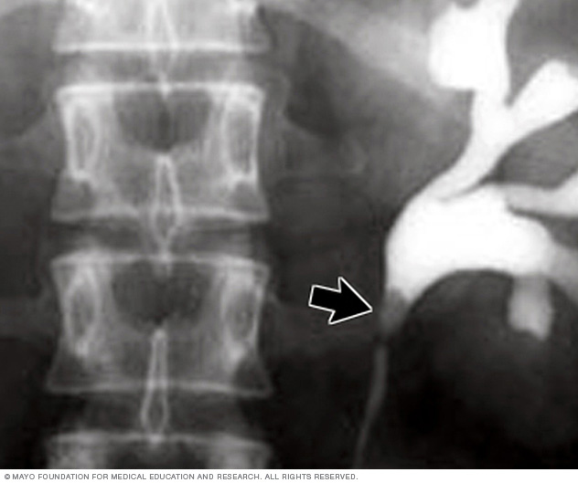 Radiografía de un cálculo renal