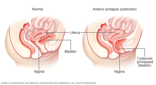 Pregnant Prolapse