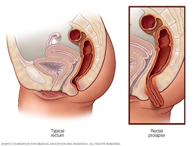 Recto normal y prolapso rectal