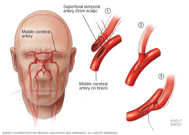 Direct revascularization procedure for moyamoya disease