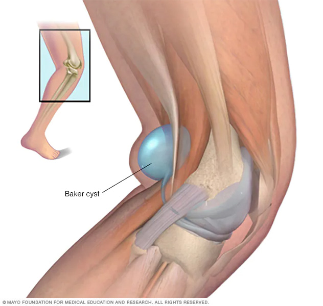 Illustration showing Baker cyst