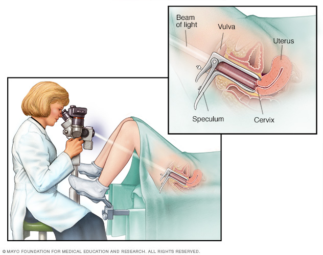 Colposcopia 