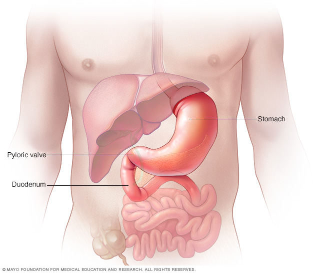 Gastritis Middlesex Health