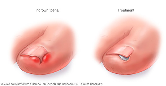 Ingrown toenail treatment