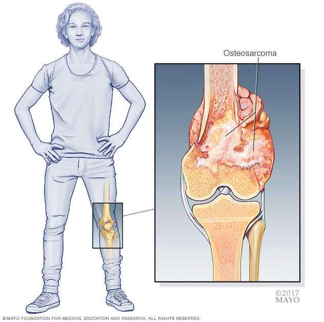 Osteosarcoma 