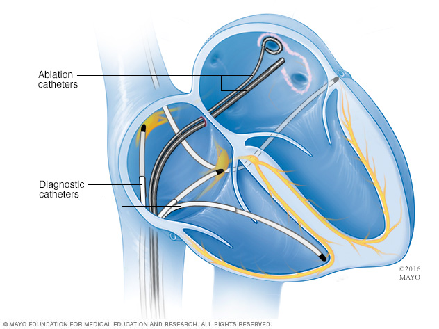 Location of catheters for pulmonary vein isolation