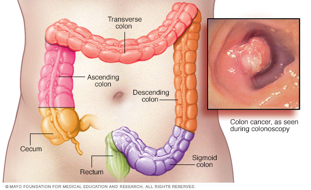 Examen para la detección de cáncer de colon 