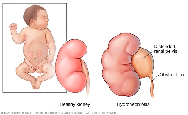 A normal kidney and a kidney with Hydronephrosis in an infant