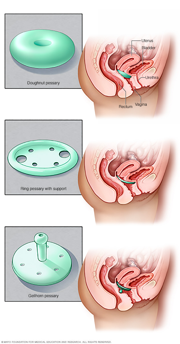 Three types of pessaries