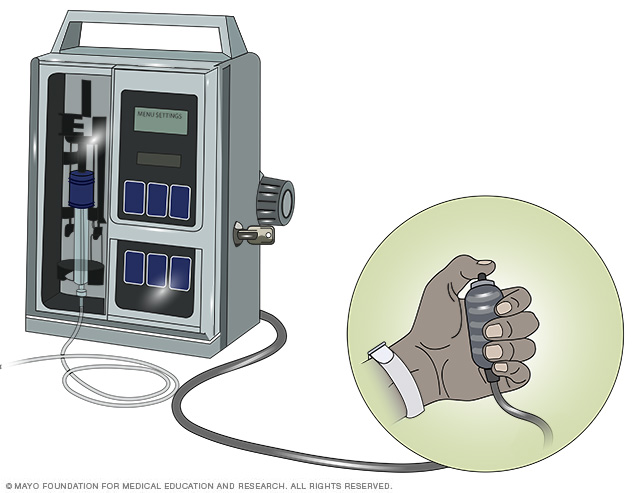 Sistema de analgesia controlada por el paciente