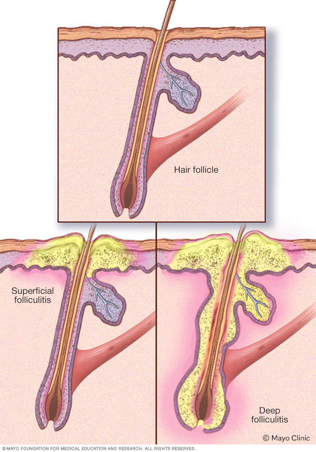 Folliculitis 