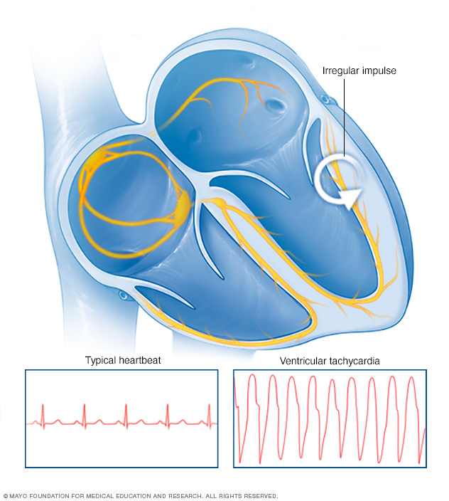 Latido de taquicardia ventricular