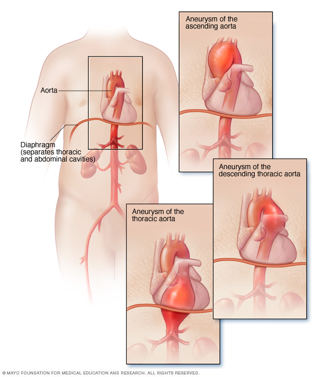 Aneurisma de la aorta torácica