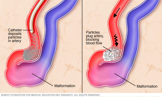 Close-up of endovascular embolization