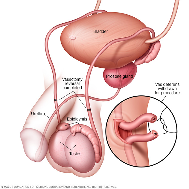 Procedimiento de reversión de la vasectomía