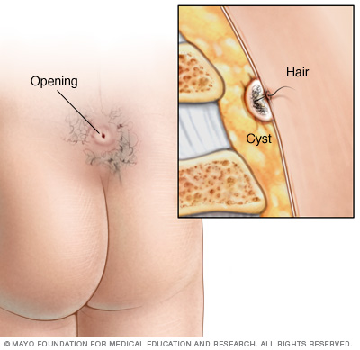 Pilonidal Sinus Disease (Pilonidal Cyst) - Dermatology Advisor