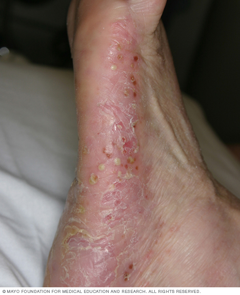 Psoriasis pustulosa 