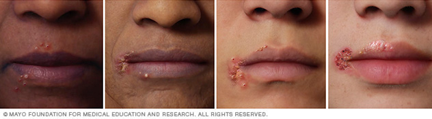 Herpes Labial Middlesex Health