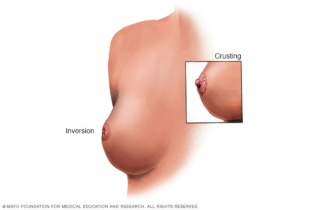 Breast rash // Middlesex Health