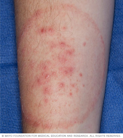 Tinea — Advanced Dermatology