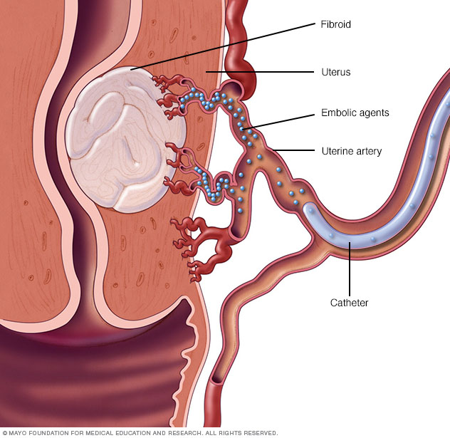 Release of embolic agents