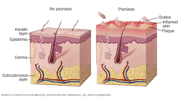 How psoriasis develops