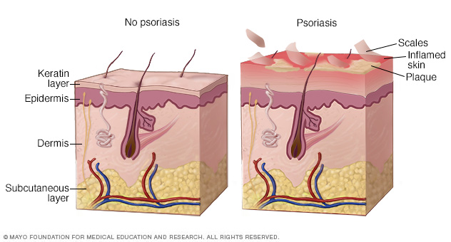 Cómo se desarrolla la psoriasis