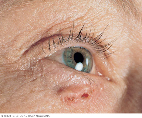 Basal cell carcinoma on white skin