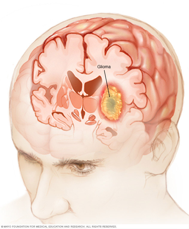 El glioma