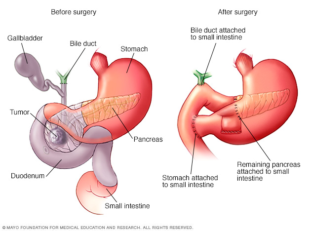 Whipple procedure