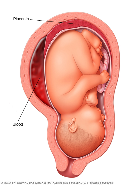 Desprendimiento de placenta 