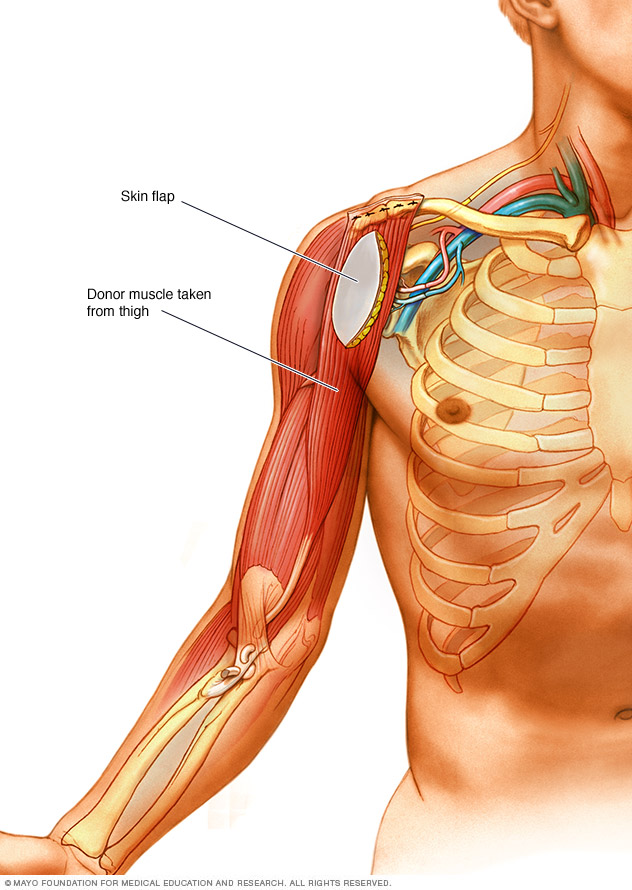 Muscle transfer