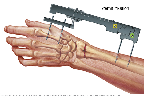 Fijación externa de una muñeca fracturada