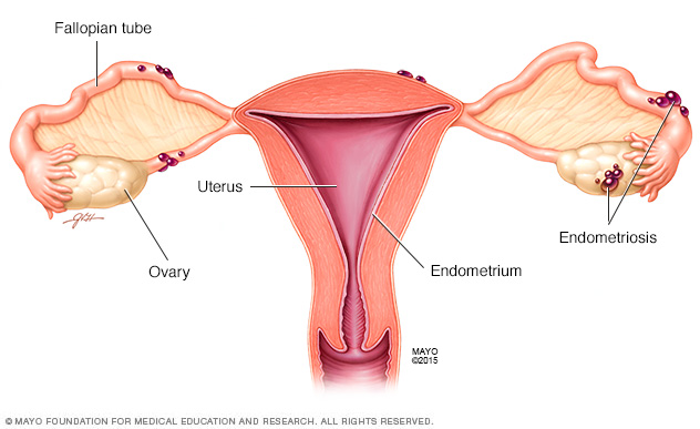 Ooforectomía (extirpación quirúrgica de los ovarios) // Middlesex Health