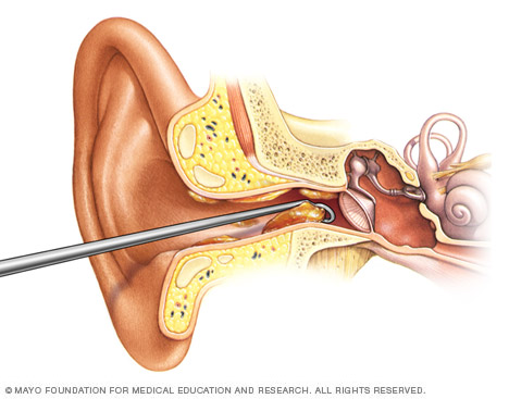 Ilustración de un médico quitando cera del oído
