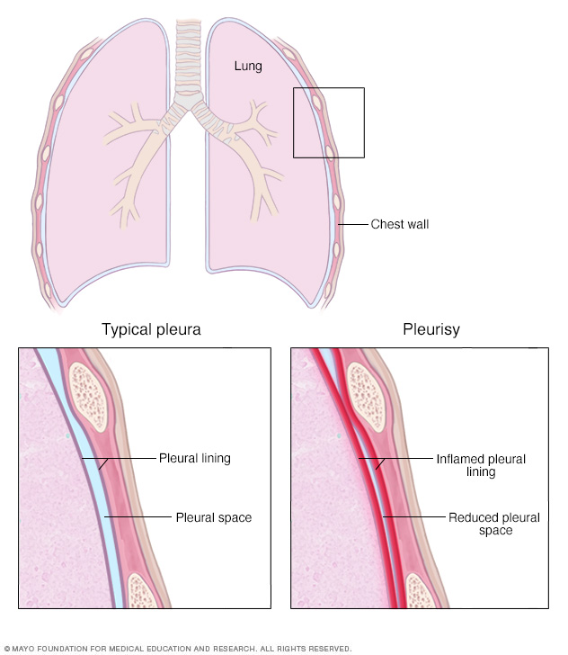 Pleura sana y pleuritis